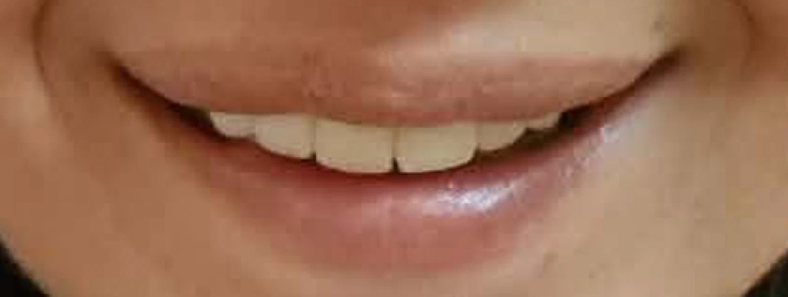 A woman with long black hair beams at the camera, highlighting her smile after successful prosthetic treatment.