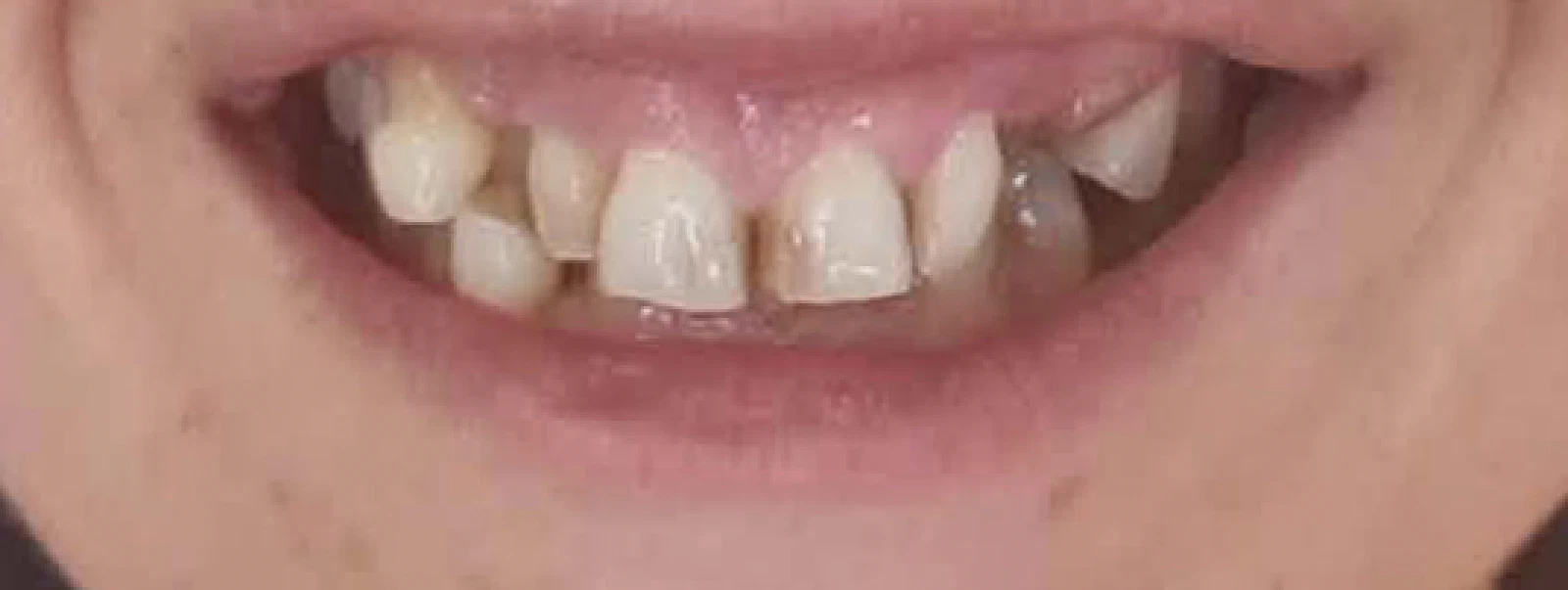 A woman smiling in a dental chair, illustrating her condition prior to undergoing prosthetic dental treatment.